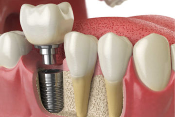Chirurgie Orală / Implantologie